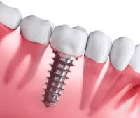 Dental+Implant-1920w