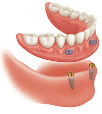 Denture+on+implants-1920w